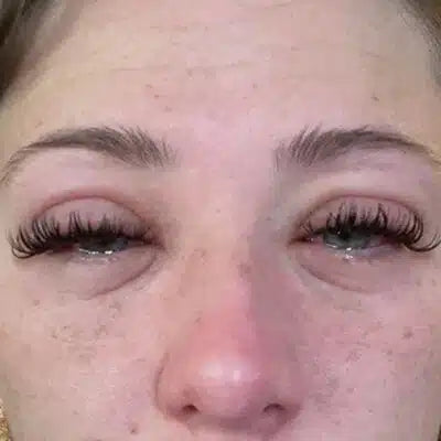 lash allergy